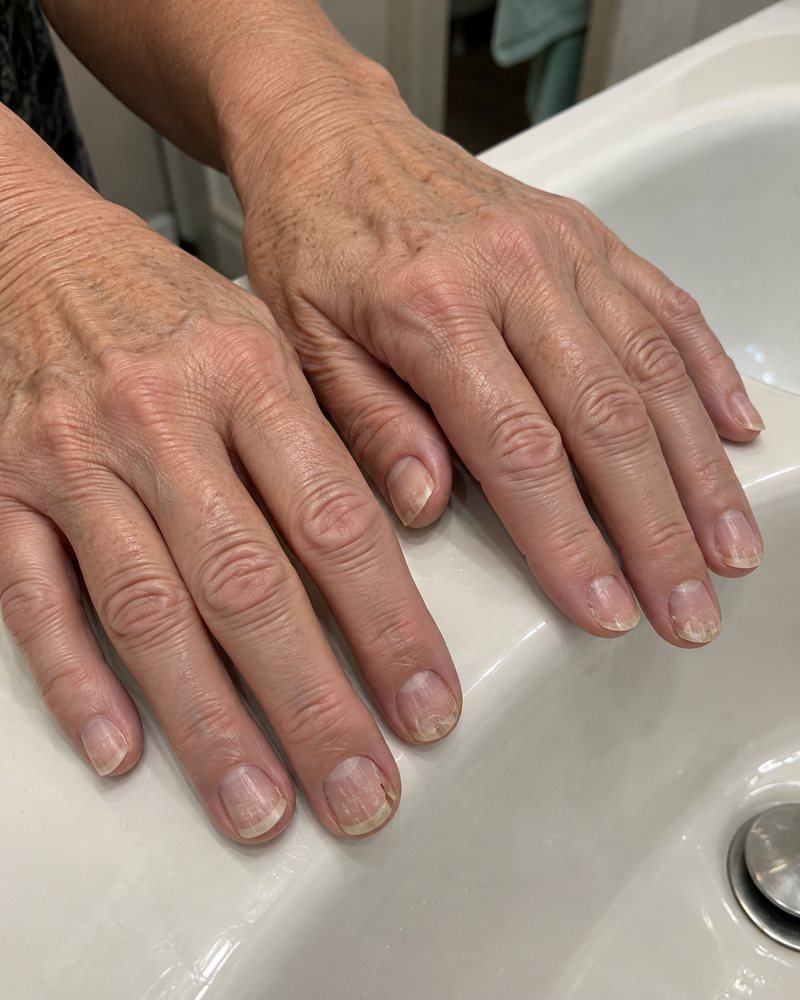 Thin peeling nails after gel