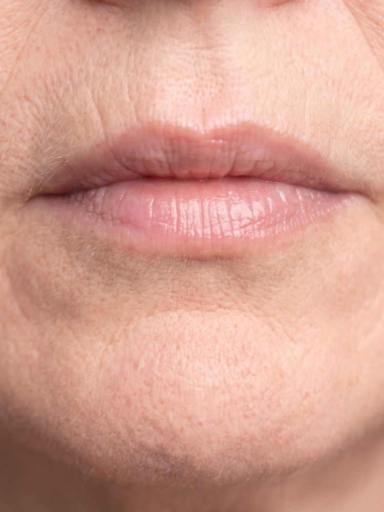Same lips after 2 weeks, slightly fuller and hydrated