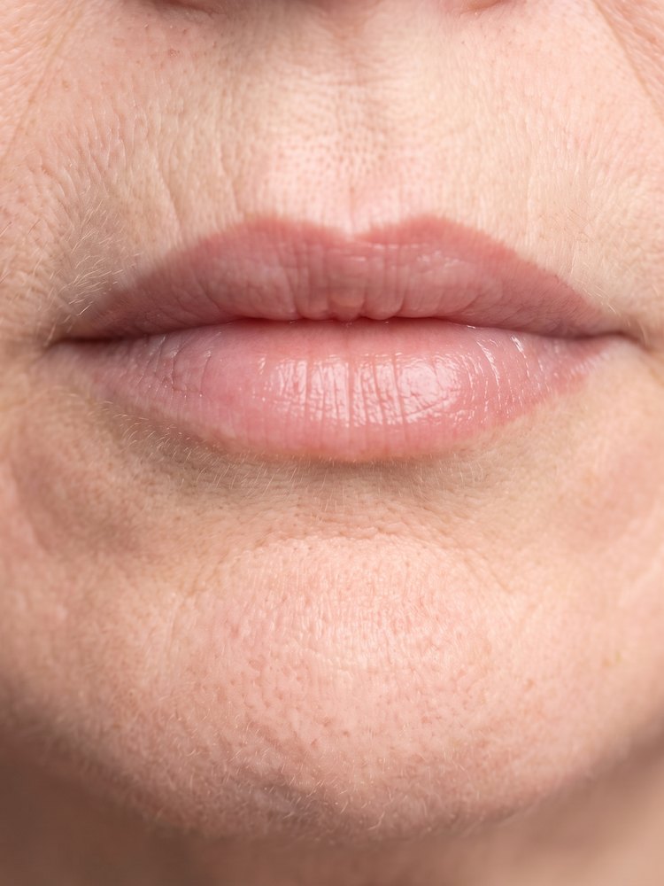 Same lips after 8 weeks, visibly fuller and smoother